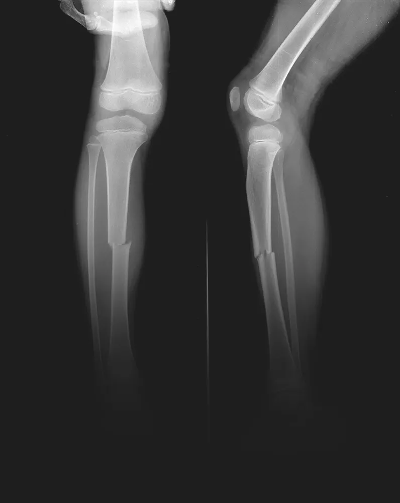 Fractures & Broken Bones