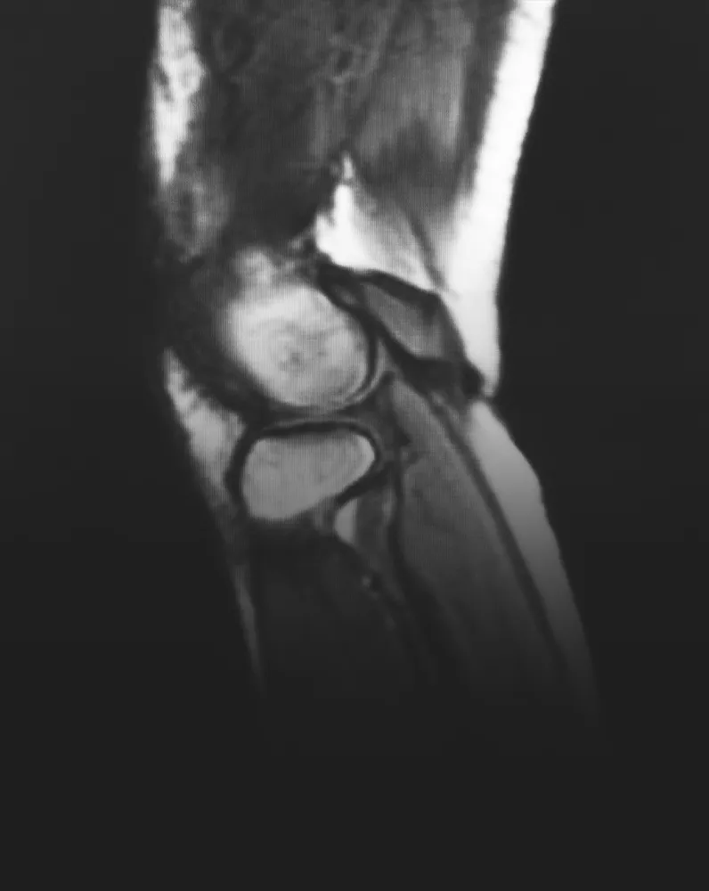 Chronic Pain & Whiplash